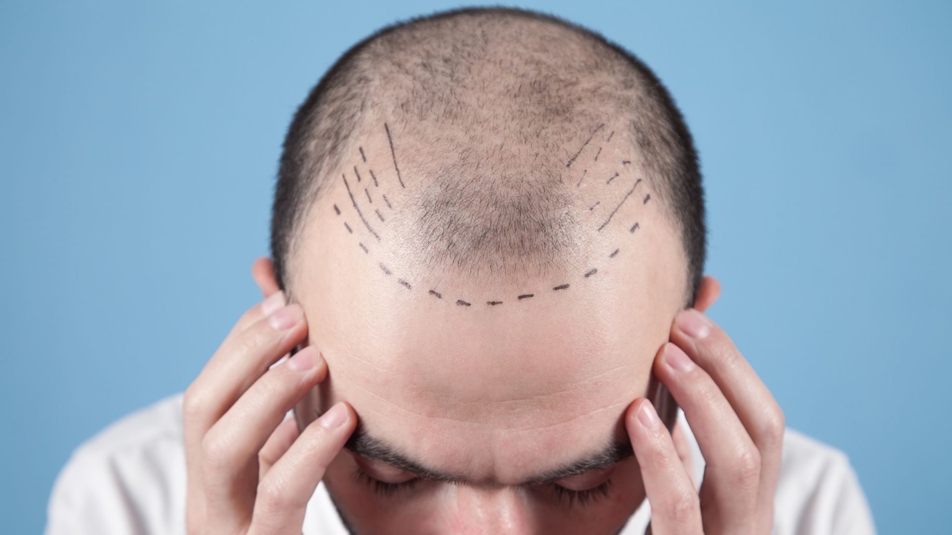 Is Istanbul Good for Hair Transplant?