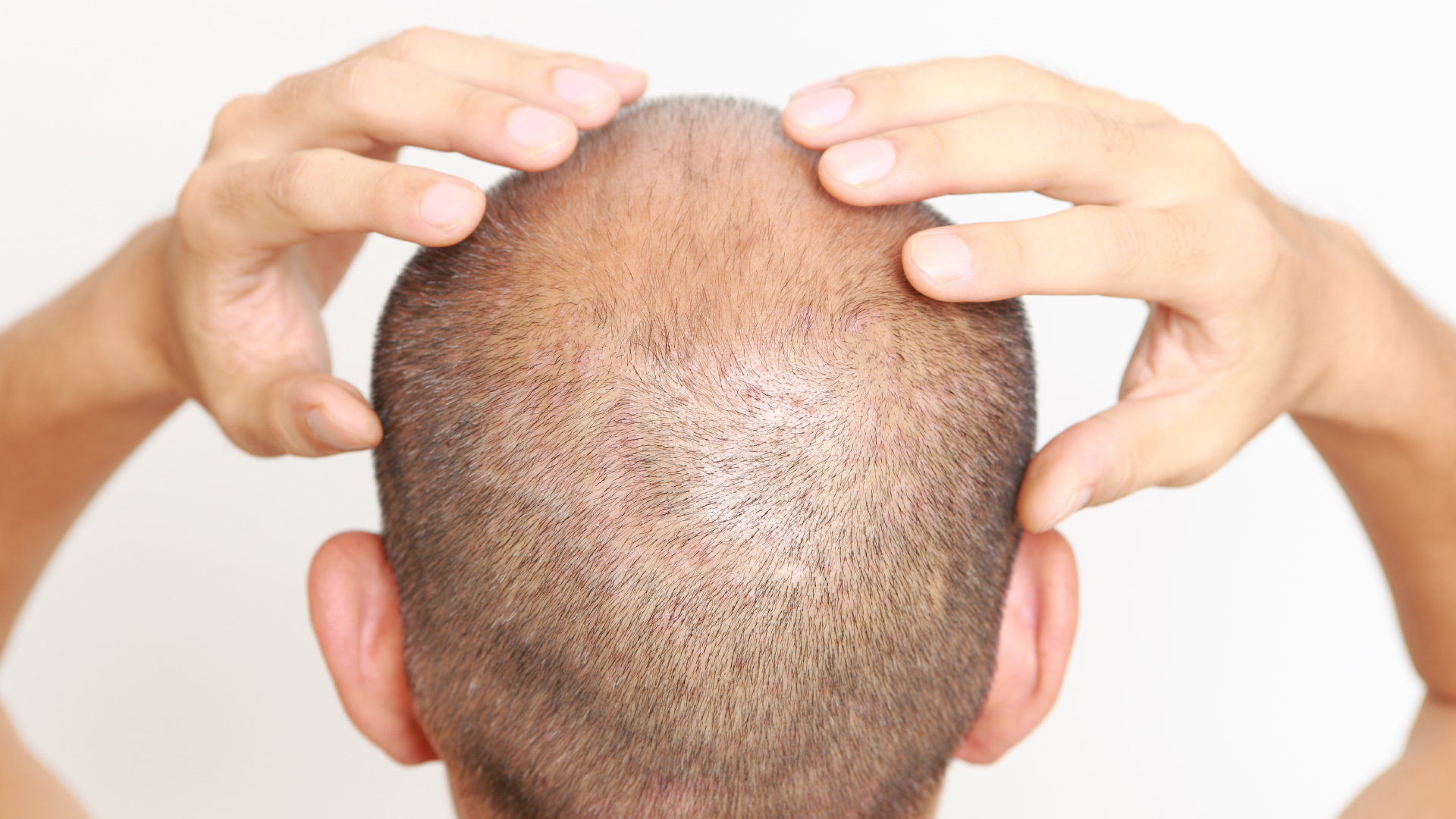 Are There Non-Surgical Alternatives to Hair Transplants?